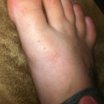 Spider bite on Adams foot