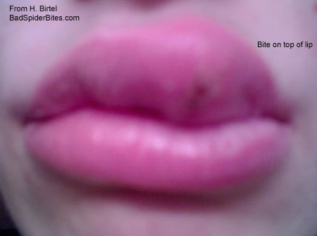 bite on upper lip