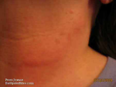 red bite on neck