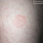 Picture of a spider bite