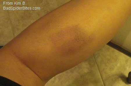 large bruise on leg