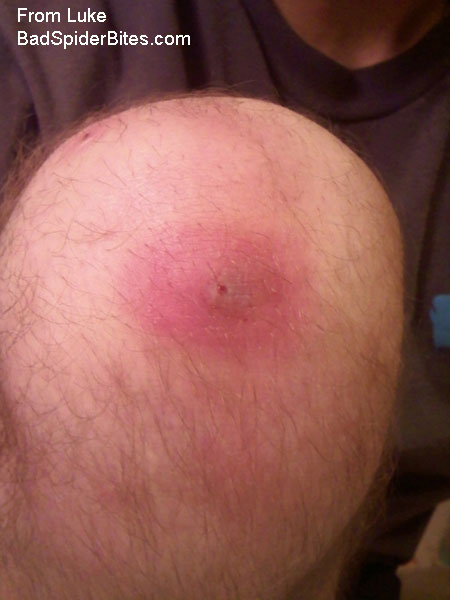 large bite on knee