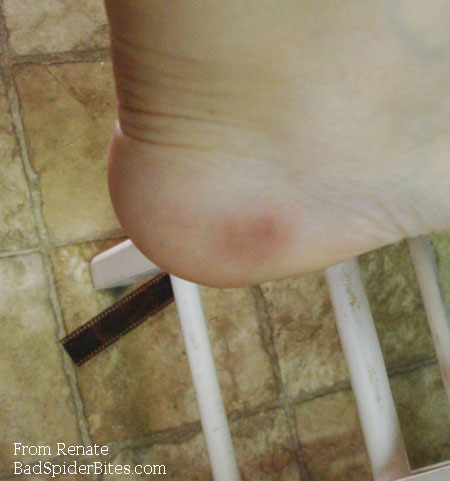 bruise on foot