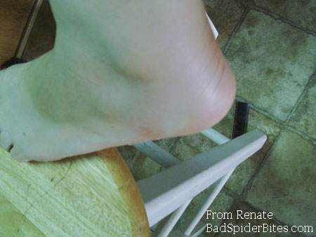 bruise on foot