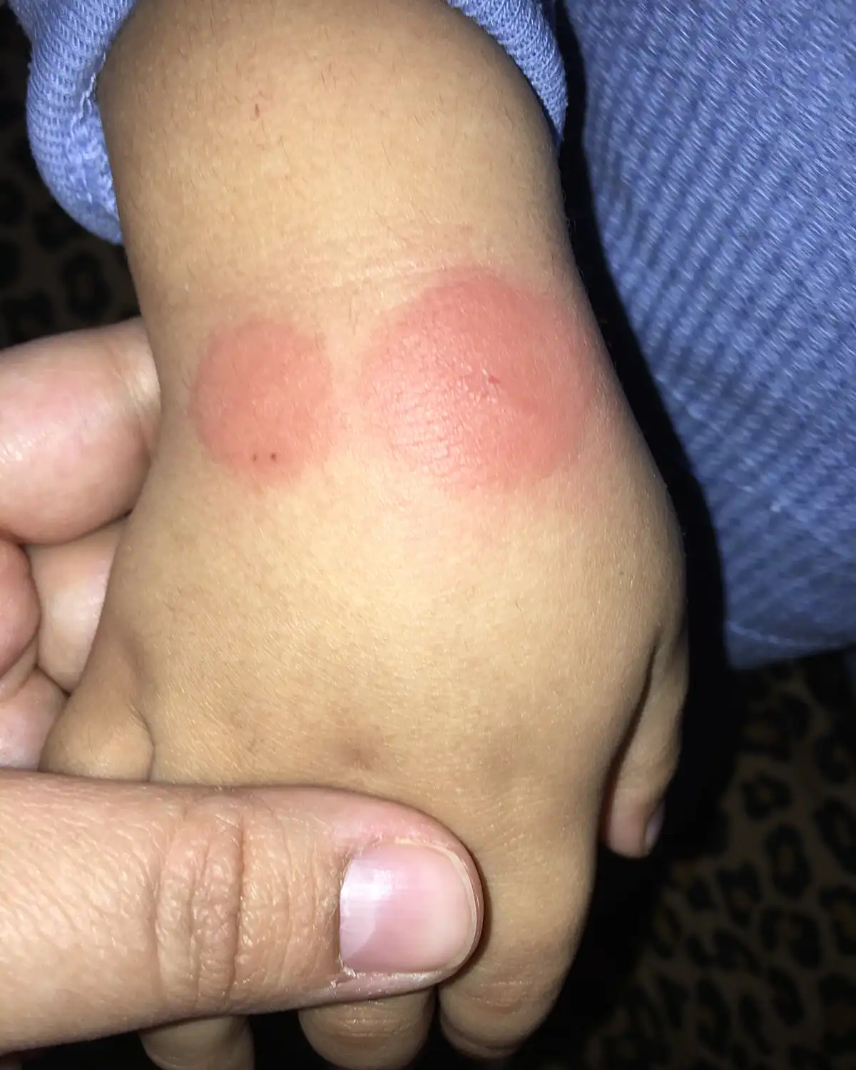 early poisonous spider bites