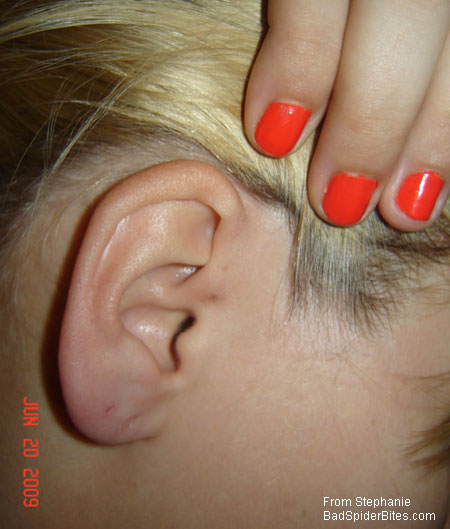 two bites on ear